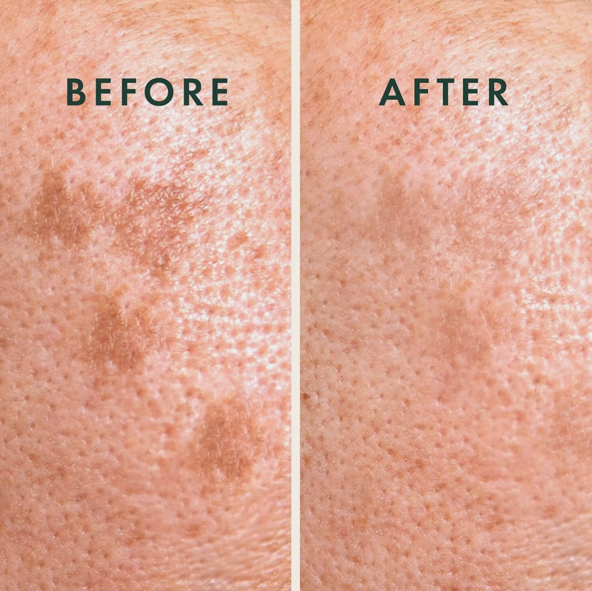 Rael Miracle Patch Microcrystal Vitamin C Dark Spot Cover, Post Acne (9 Count)